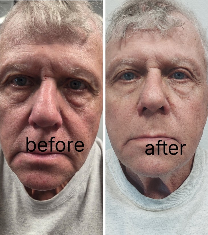 Before And After Face Wrinkle